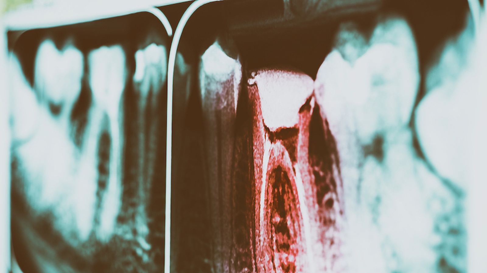 Could Root Canal Be Linked to Cancer?
