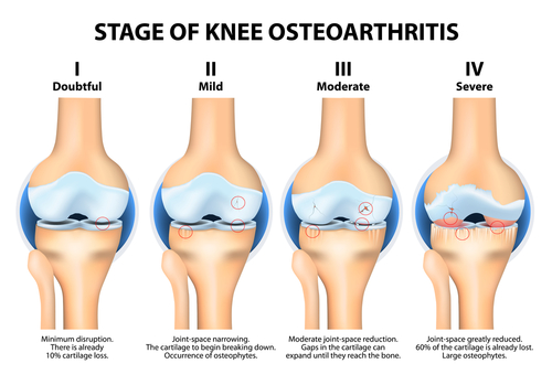 Stages of osteoarthritis of the knee joint