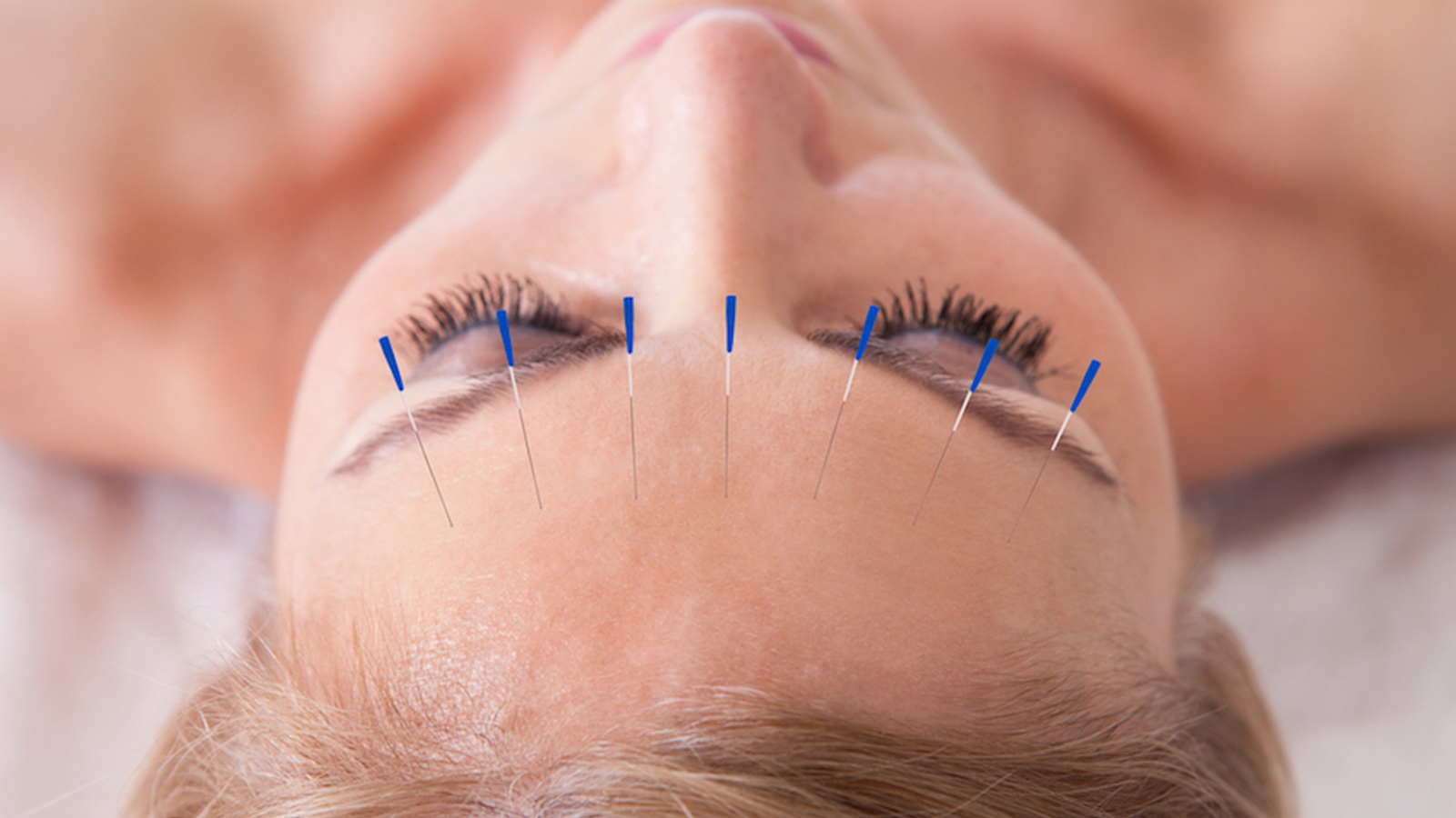 Things You Did Not Know About How Acupuncture Can Help You