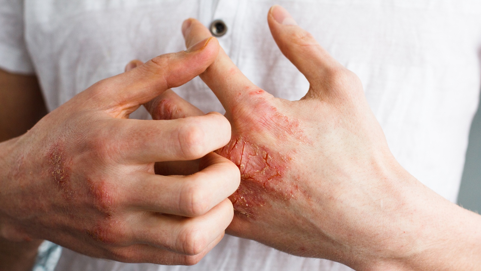 5 Unusual Causes of Eczema & How To Get Relief Naturally