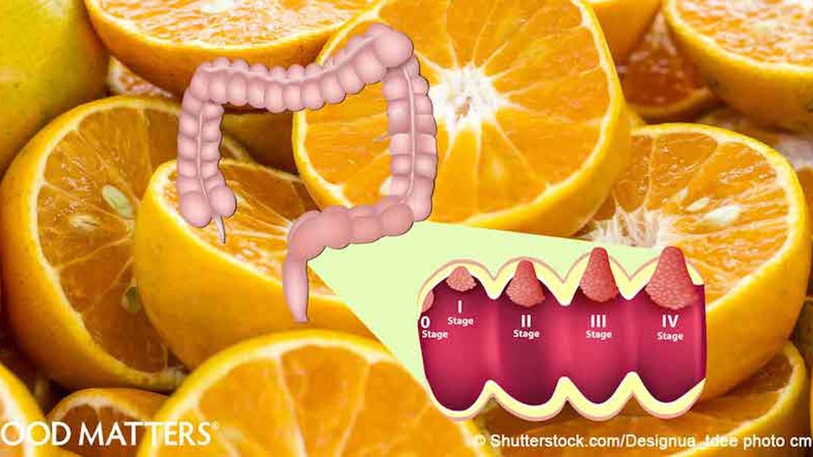 Vitamin C Can Kill Colorectal Cancer Cells!
