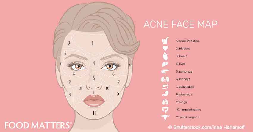 Acne Face Chart Meaning