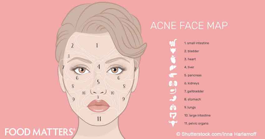 Acne Zone Chart