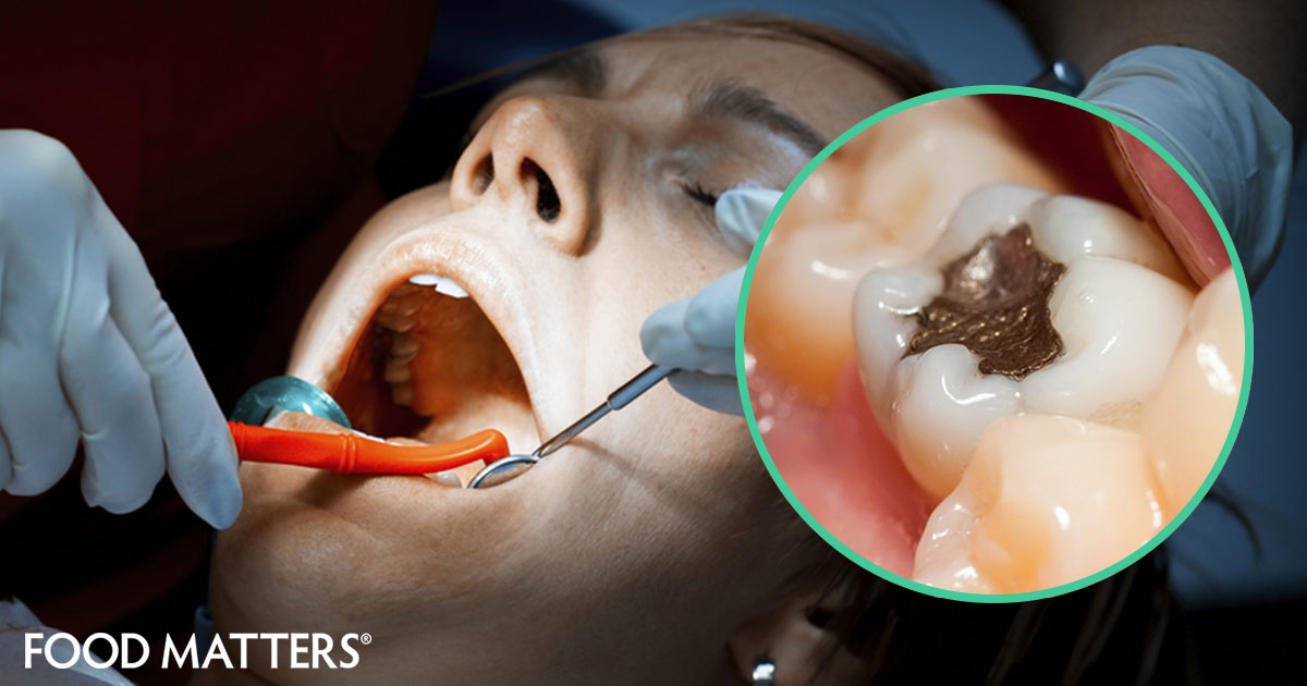 Mercury Madness a Why have Norway and Sweden banned amalgam fillings