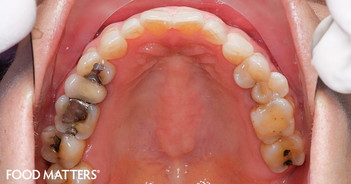 symptoms of mercury poisoning from fillings